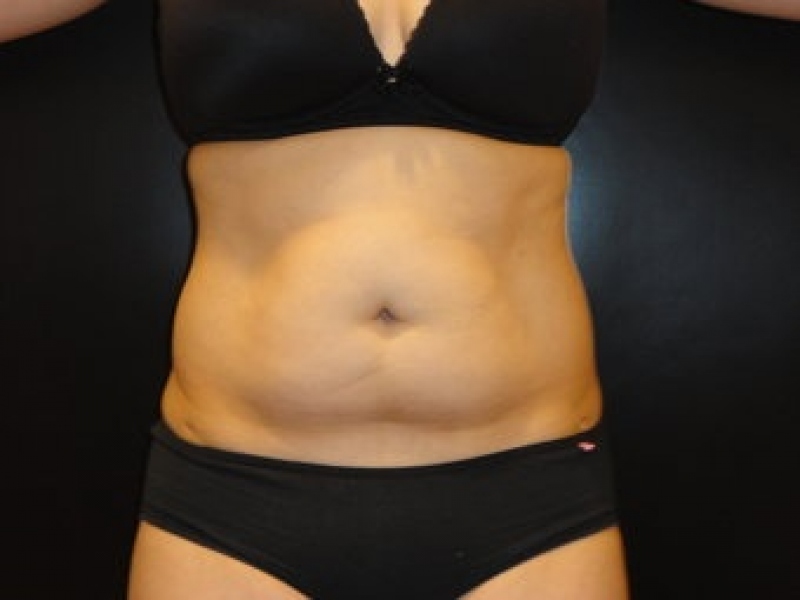 Smartlipo 