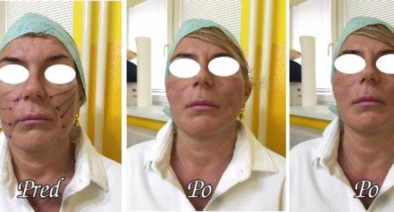 Facelifting Aptos